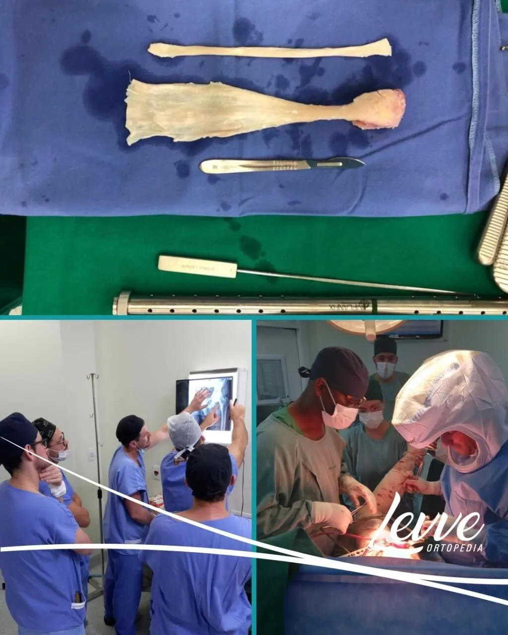 levve transplante osseo hospital sao jose