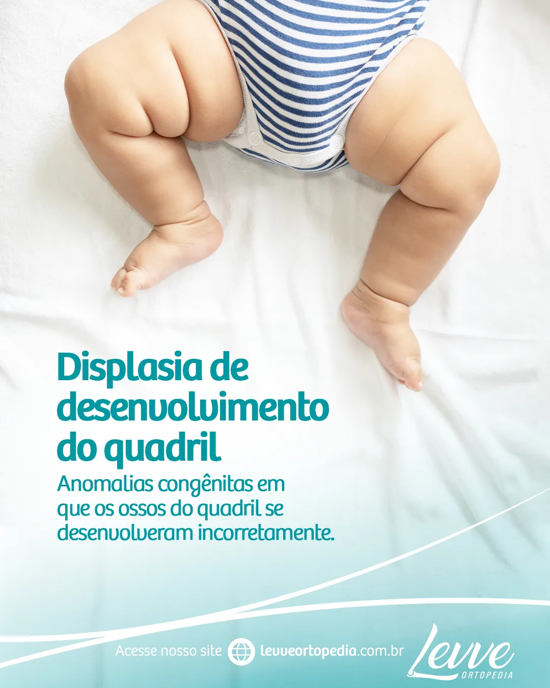 Displasia de Desenvolvimento do Quadril